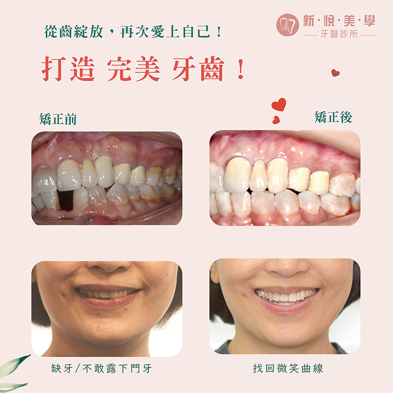 超神奇！ 隱形矯正補回妳的牙的第2張圖片